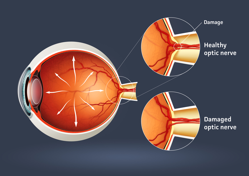 glaucoma